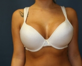 Feel Beautiful - Breast Augment San Diego, Case 59a - After Photo